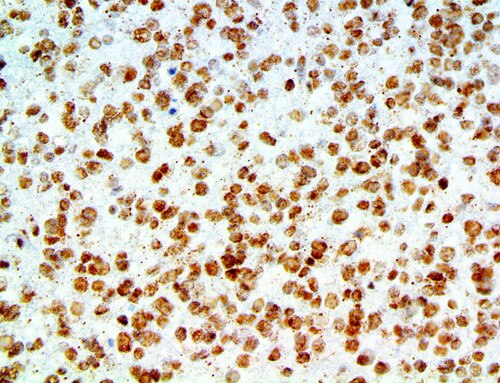 IHC of Amyloid Beta on an FFPE Astrocytoma Tissue
